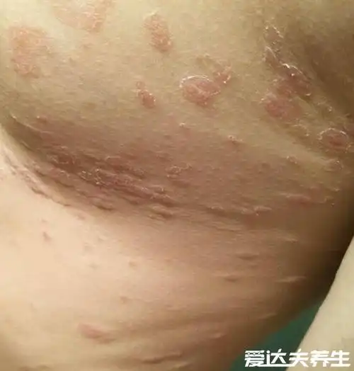 玫瑰糠疹图片及症状