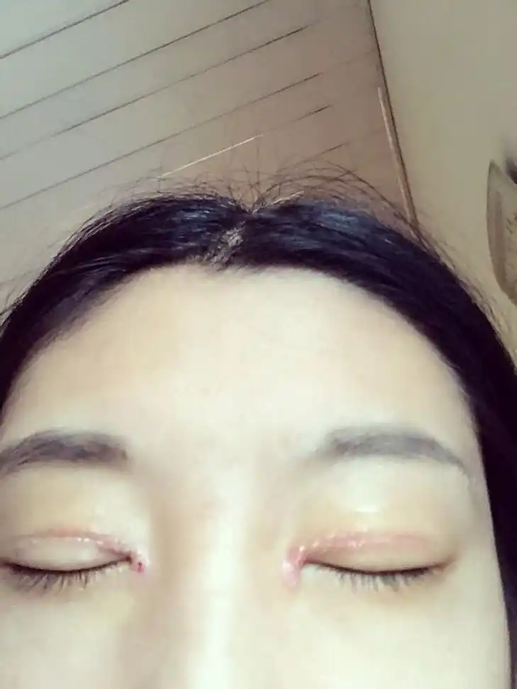 做完双眼皮开眼角手术出现十天了,七天拆线时候发现就有增生疤痕挺重
