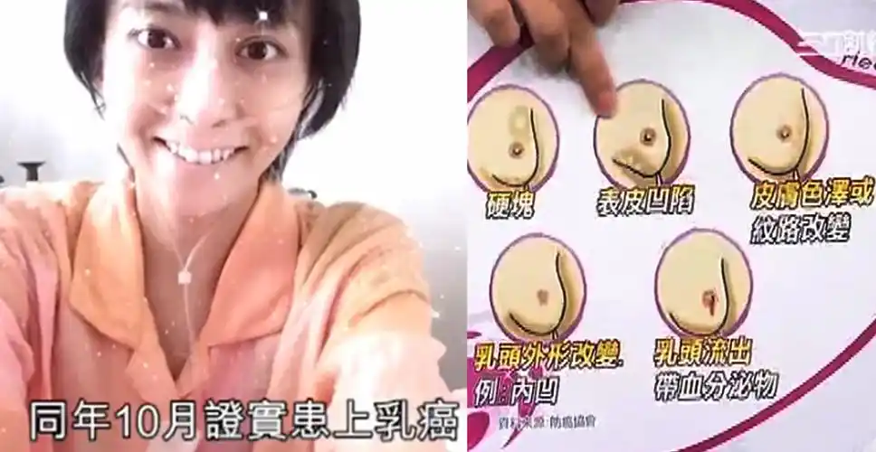乳腺癌的早期症状和前兆(乳腺癌的早期症状和前兆橘皮状图案)