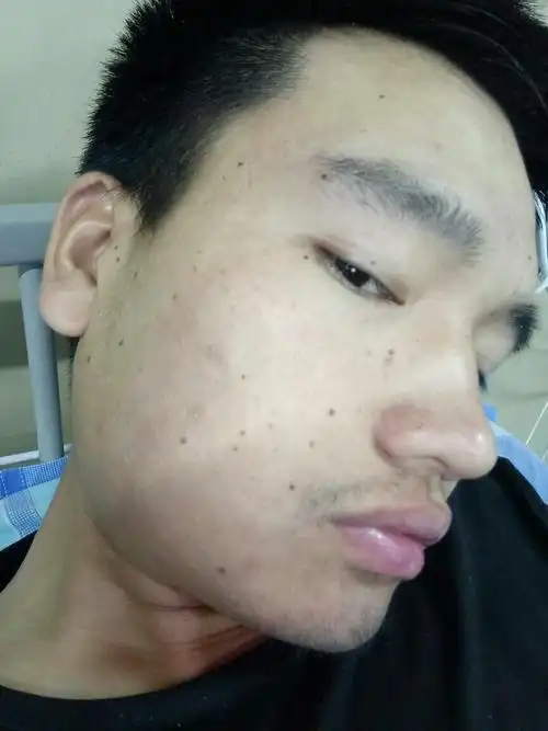 脸上的黑点怎么治