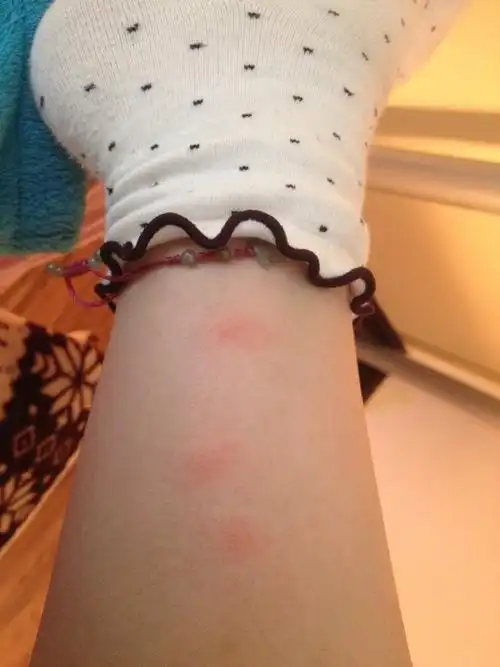 荨麻疹症状图片及病因