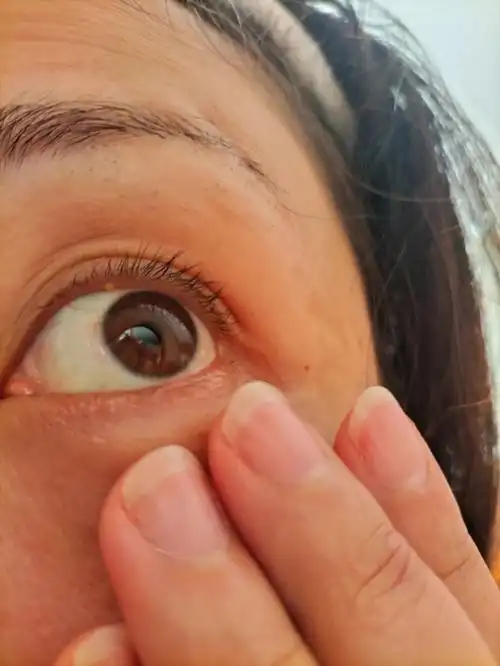 麦粒肿水泡神药呀