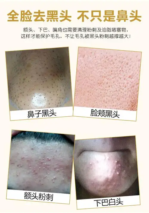 木二三四七撕拉面膜去黑头粉刺闭口套装深层清洁收缩毛孔堵塞污垢男