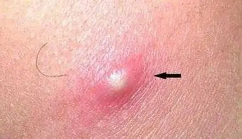 艾滋病患者的6种皮肤病变