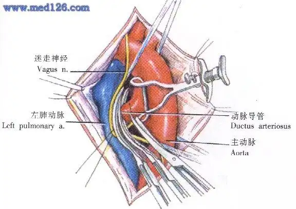 动脉导管未闭手术操作步骤,图片图谱图解,手术治疗方法,诊断血管手术