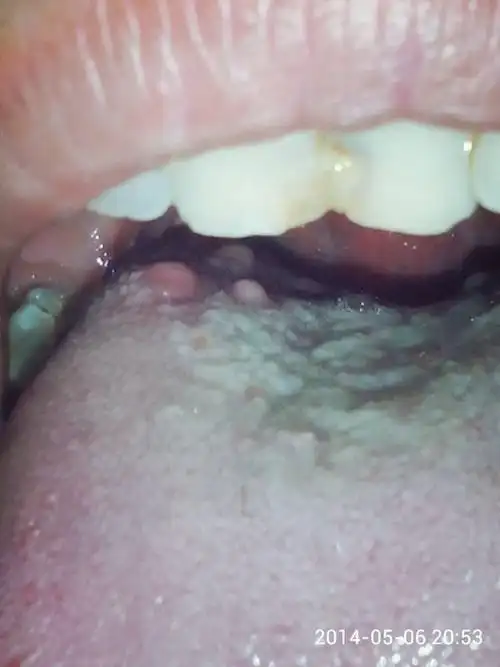 男的舌根长肉疙瘩几年了吞咽比较困难