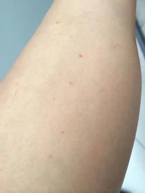 问:腿上长红点点.