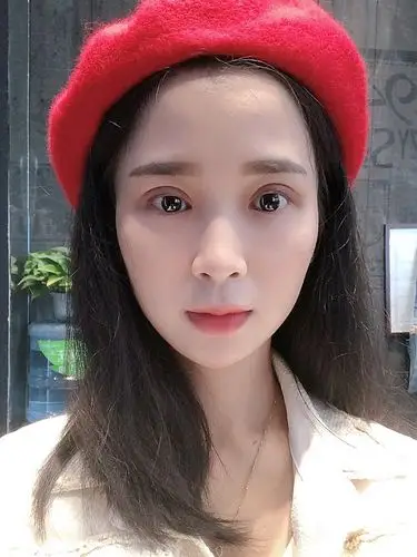 无痕双眼皮术后第十天!