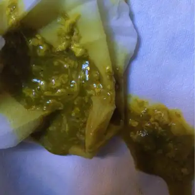 我想问下宝宝拉这样的粑粑正常吗?裏面那种棉花状的是啥玩意啊!谢谢!