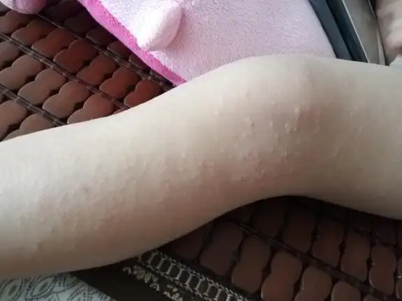 急急急宝宝得了沙土性皮炎越来越严重擦药喝药都没用