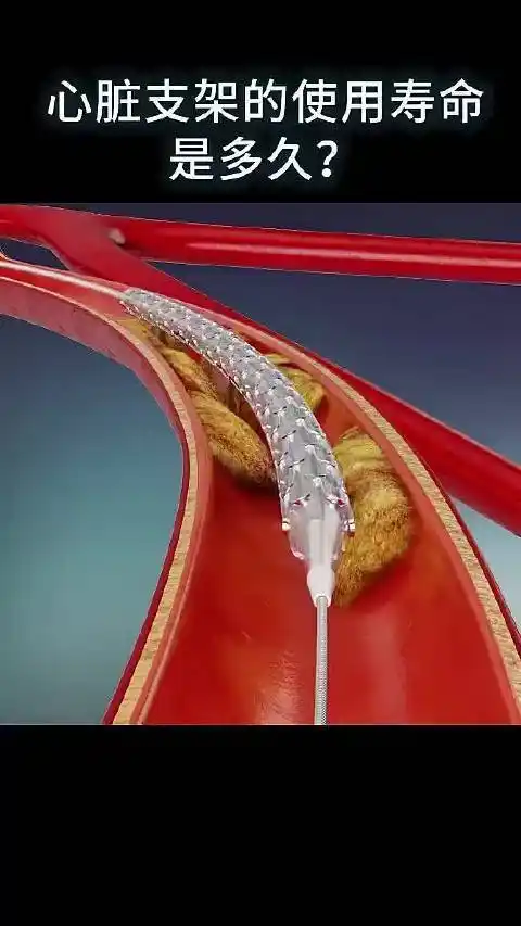 心脏支架的使用寿命是多久?-度小视
