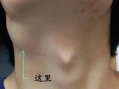 颈上淋巴结肿大图片