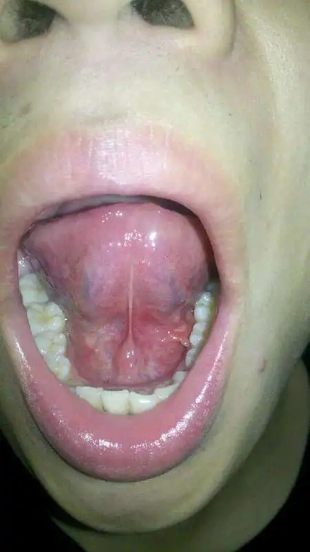 我想问我舌头下面长的是什么东西(附图)