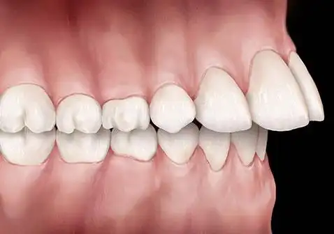 龅牙图片真人图片