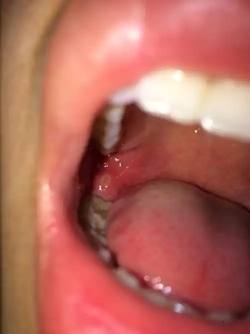 牙龈最后一颗牙齿旁边溃烂了一个白色小洞! 看图 怎么办