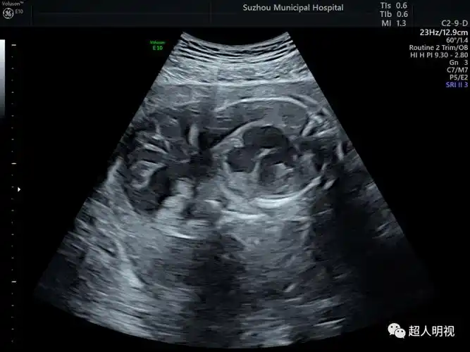两个病例_胎儿_分析_解剖