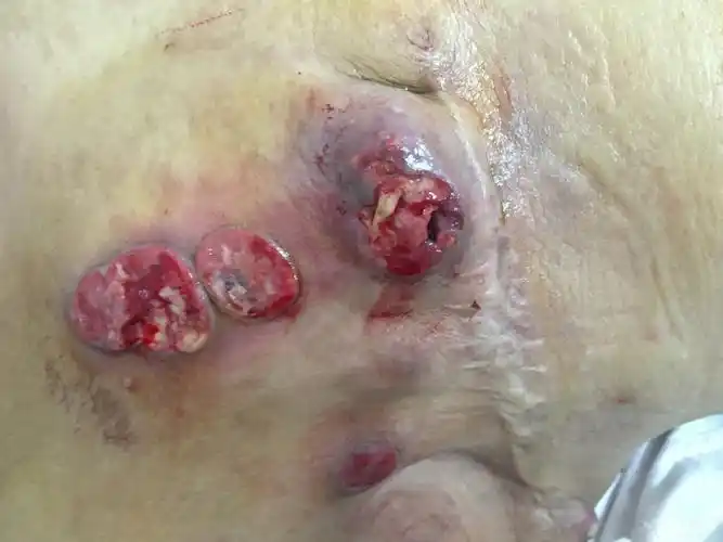 求帮忙,乳腺癌术后皮肤复发的 [病例帖]