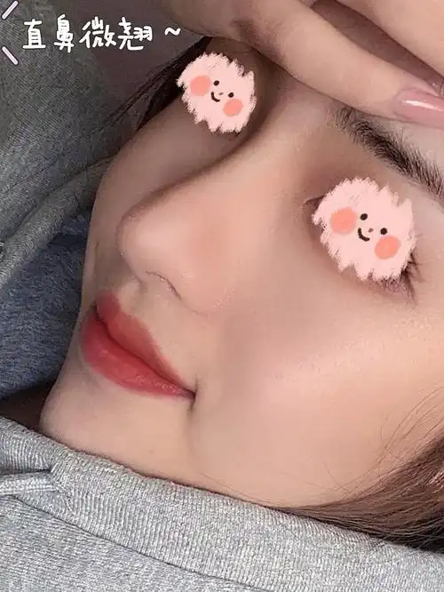 直鼻微翘重点#肋软骨鼻部多项