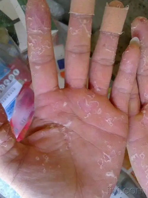 手足脱皮1周 - 皮肤及性传播疾病讨论版 - 爱爱医医学论坛