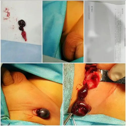 小儿隐睾合并扭转坏死