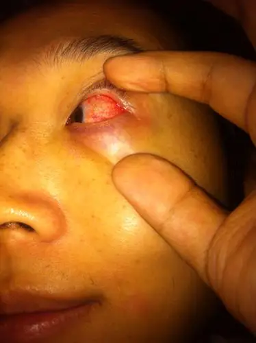 这是什么问题啊…眼白有水肿…?