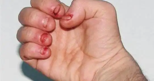 咬指甲手指坏死的恐怖图片 而且没办法弄只能这样子