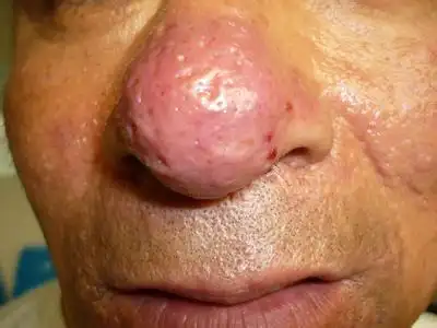 痘|黄褐斑|皮肤黑变病|小儿皮肤湿疹|痤疮|酒糟鼻|尖锐湿疣等疑难皮