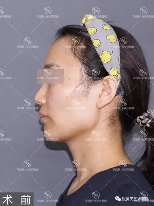下颌角外翻型方脸截骨瘦脸2个月遇见更美侧颜
