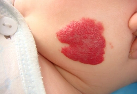 这种血管瘤应该选用什么治疗啊?