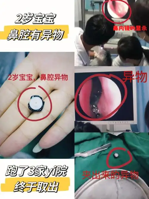 宝宝鼻子有异物跑了三家yi院终于取出来了