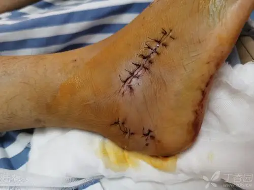 双侧跟骨骨折跗骨窦切口内固定手术 - 骨科专业讨论版 -丁香园论坛