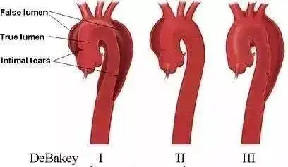 肾内科李大夫|主动脉夹层,生命鬼门关