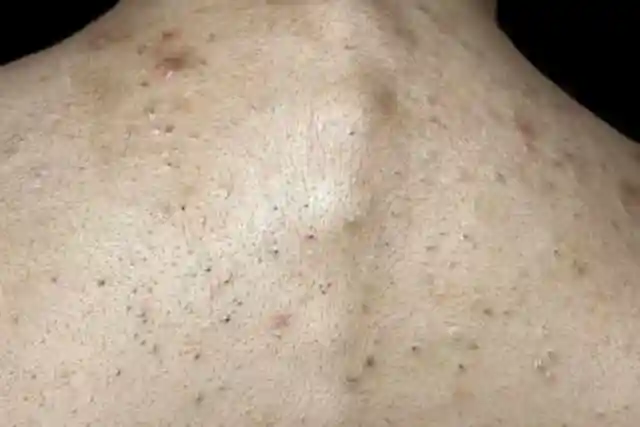 背上有螨虫的人,一般都会出现这3种情况,教你3招轻松去螨虫_网易订阅