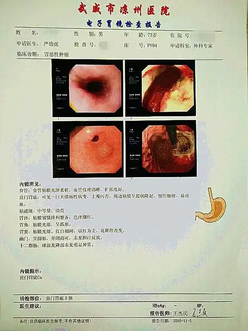 加速康复外科——患者的福音(第三集) 身患胃癌6年 ,今日才手术切除