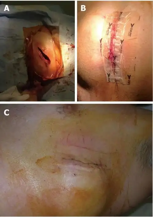 新的皮肤闭合系统促进心脏起搏器植入手术后伤口的愈合
