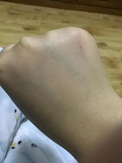 被猫抓了一下出了血丝需要打狂犬疫苗吗