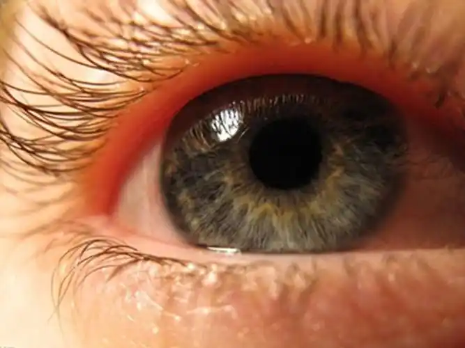 青光眼人眼图片