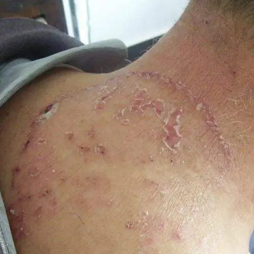 股癣恢复图片男性手臂体股癣图片男性手臂体股癣的图片男性手臂的体