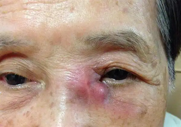 眼科医生提醒民众别轻忽鼻泪管阻塞的严重性,若任意置之不理,一旦鼻