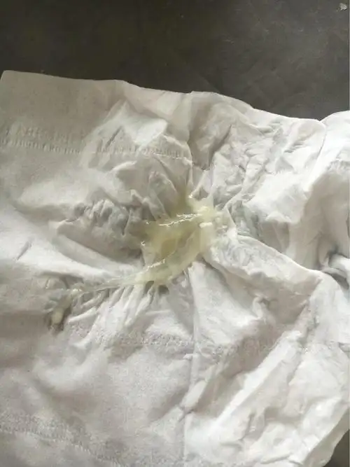 今天下午突然流出来的一坨,这是白带还是什么呀,没有血,也不腹痛,现在