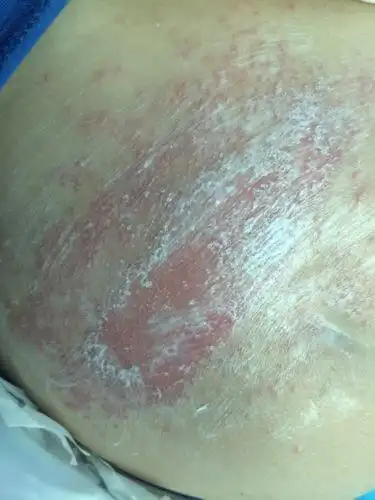 三岁宝宝臀部长出好多一块一粒的东西