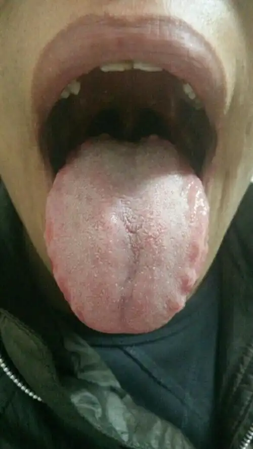 舌头上长了很多肉粒圆圆