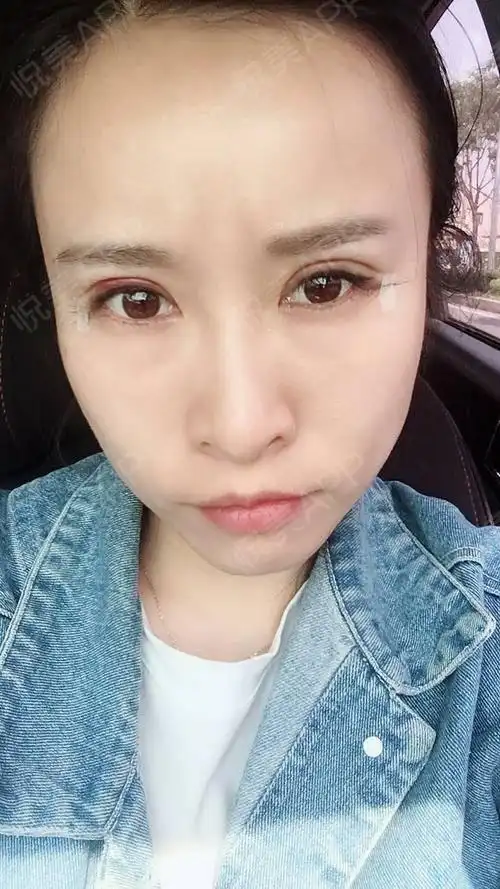 全切双眼皮术后3天_开眼角术后3天_双眼皮术后3天_眼部整形术后3天