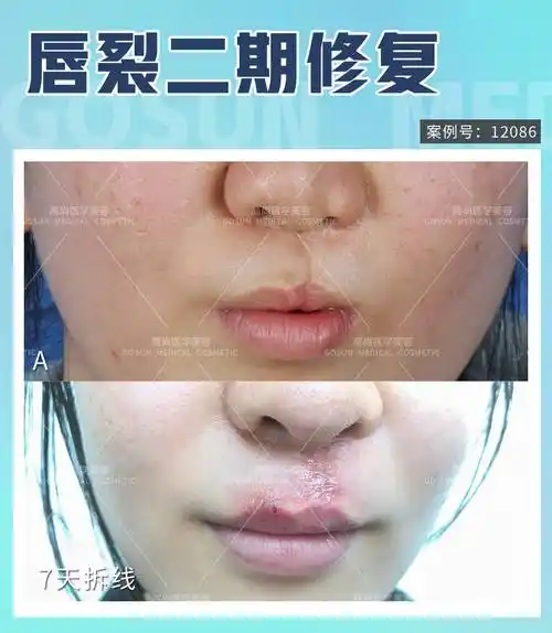 唇裂二期修复手术可以毫无痕迹地修复好吗