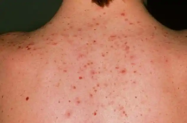 背上有螨虫的人可多用3个妙招除螨螨虫都被排空空