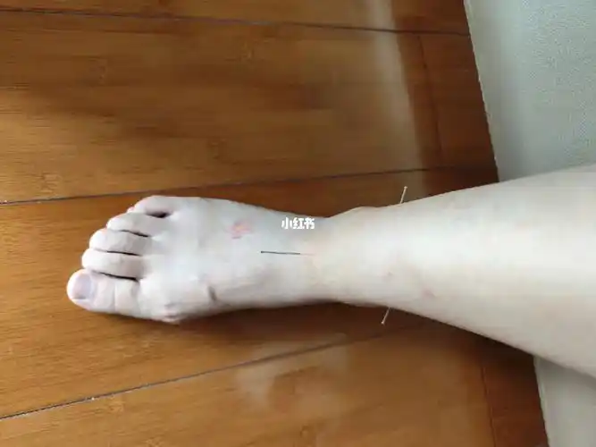 脚踝一年前骨折过,到现在还是没好利索,走路走多了脚踝就木木的,脚