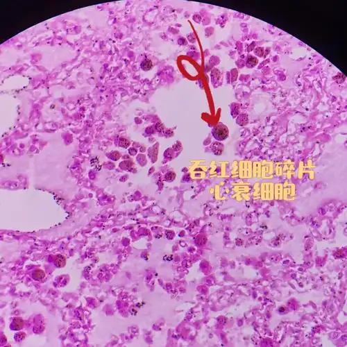 慢性肺瘀血时,巨噬细胞吞噬红细胞碎片,血红蛋白被溶酶