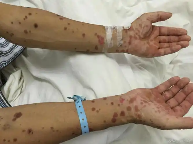 多形红斑型药疹