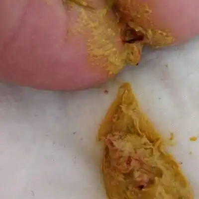 也没有出现这个情况,上图片看下,检查肛门和化验便便,都是没事的 茗