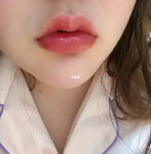 玻尿酸丰唇一周了